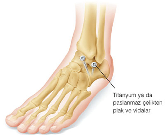 Ayak Bileği Ayak Bileği
