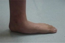 Taban Çökmesi Belirtileri ve Tedavisi