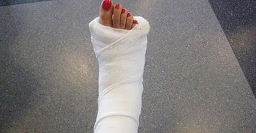 Alçıdan Çıkan Ayak