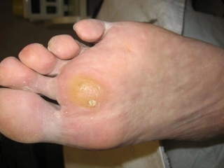 Ayak Altında Su Toplaması ve Tedavisi