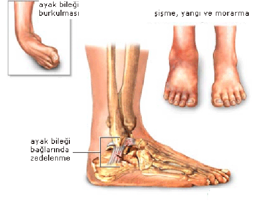 Ayak Düşmesi Belirtileri ve Tedavisi
